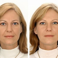 faltenunterspritzung, lippenvergrößerung, lippenaufbau, Lipolyse, hyaluronsäure