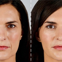 faltenunterspritzung, lippenvergrößerung, lippenaufbau, Lipolyse, hyaluronsäure