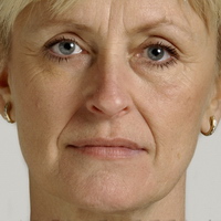 faltenunterspritzung, lippenvergrößerung, lippenaufbau, Lipolyse, hyaluronsäure