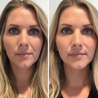 faltenunterspritzung, lippenvergrößerung, lippenaufbau, Lipolyse, hyaluronsäure