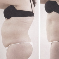 wett weg anti cellulite abnehmen kavitation lörrach steinen