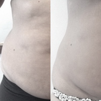 wett weg anti cellulite abnehmen kavitation lörrach steinen