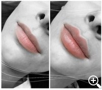 faltenunterspritzung, lippenvergrößerung, lippenaufbau, Lipolyse, hyaluronsäure