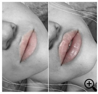 faltenunterspritzung, lippenvergrößerung, lippenaufbau, Lipolyse, hyaluronsäure