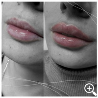 faltenunterspritzung, lippenvergrößerung, lippenaufbau, Lipolyse, hyaluronsäure