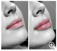 faltenunterspritzung, lippenvergrößerung, lippenaufbau, Lipolyse, hyaluronsäure
