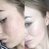 gesichtsbehandlung gesichtsreinigung gesicht behandlung reinigung lörrach basel steinen kosmetikstudio kosmetikerin kosmetik acne