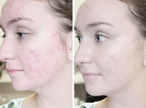 gesichtsbehandlung gesichtsreinigung gesicht behandlung reinigung lörrach basel steinen kosmetikstudio kosmetikerin kosmetik acne